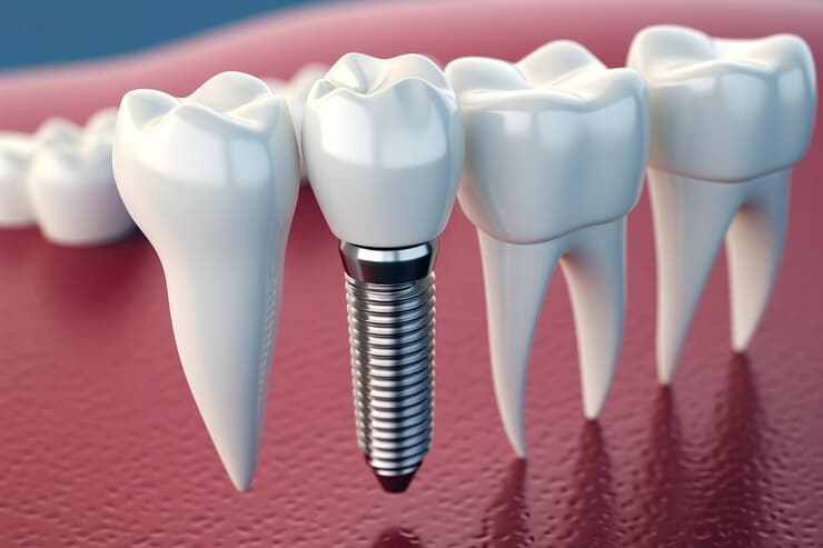 How Dental Implants Could Actually Increase Your Lifespan?