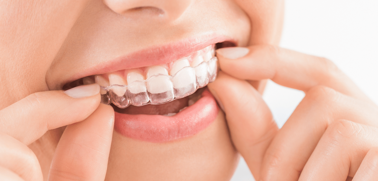 Day One With Invisalign: What To Expect?