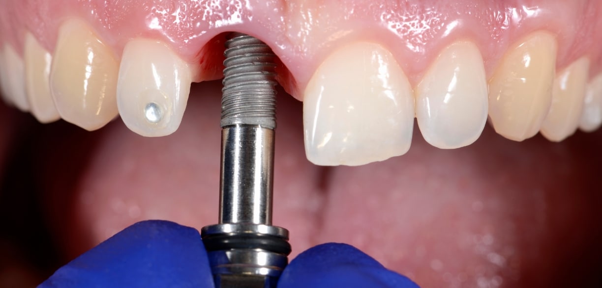 How Gums Grow And Bond To Dental Implant Teeth: Explained
