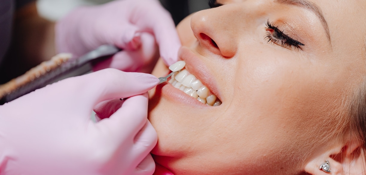 Maintain Your Dental Veneers: 5 Essential Aftercare Tips