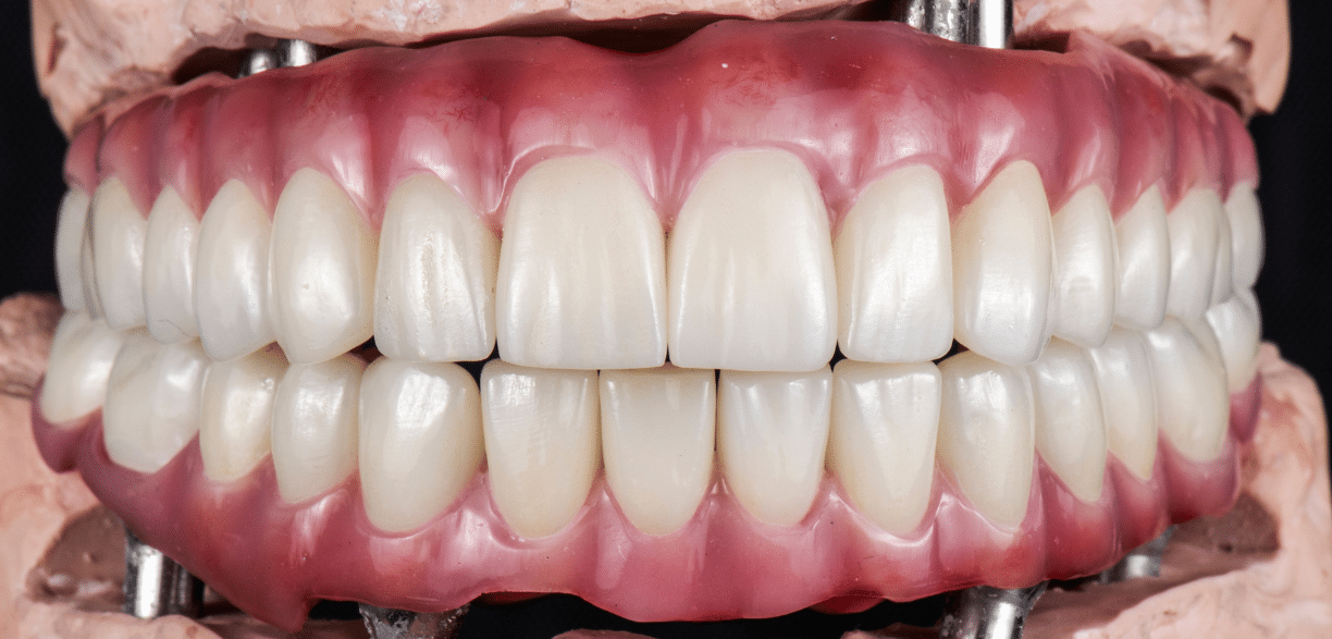 Can Dental Implants Be Used for a Full Mouth Restoration?