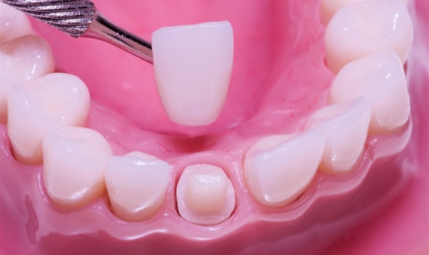 Care Tips for Longevity of New Dental Crown