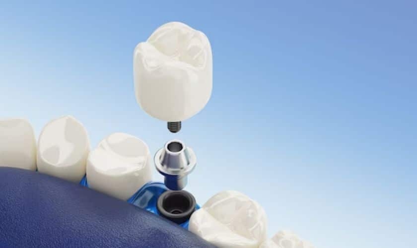 Dental Implants in Encino CA