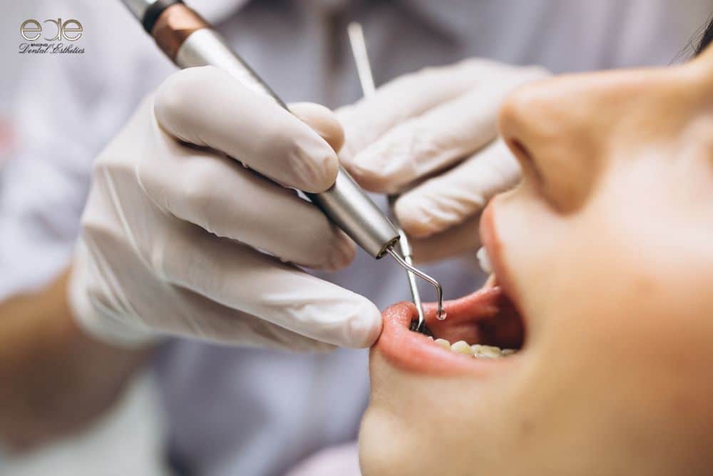 Dental Implants in Encino, CA