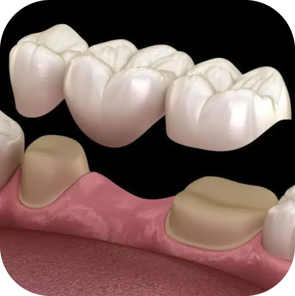 dental-bridges