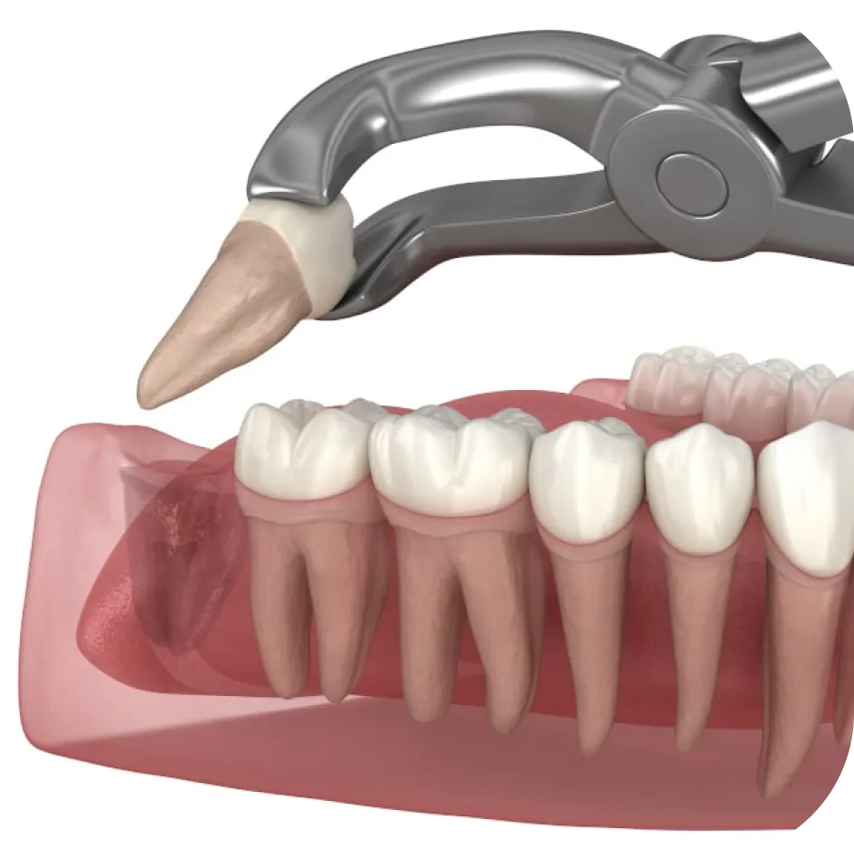 wisdom tooth extraction
