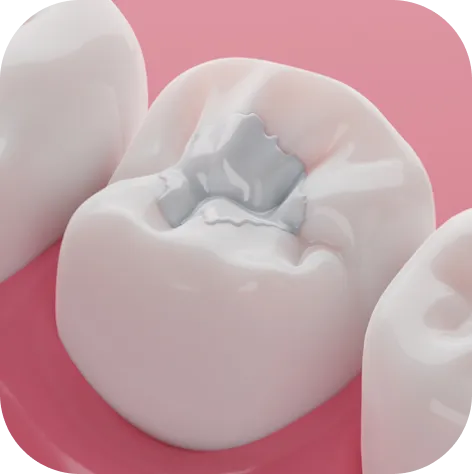 white fillings for a tooth