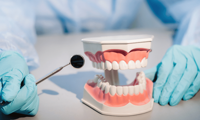 Dental Bridges Vs Dental Implants