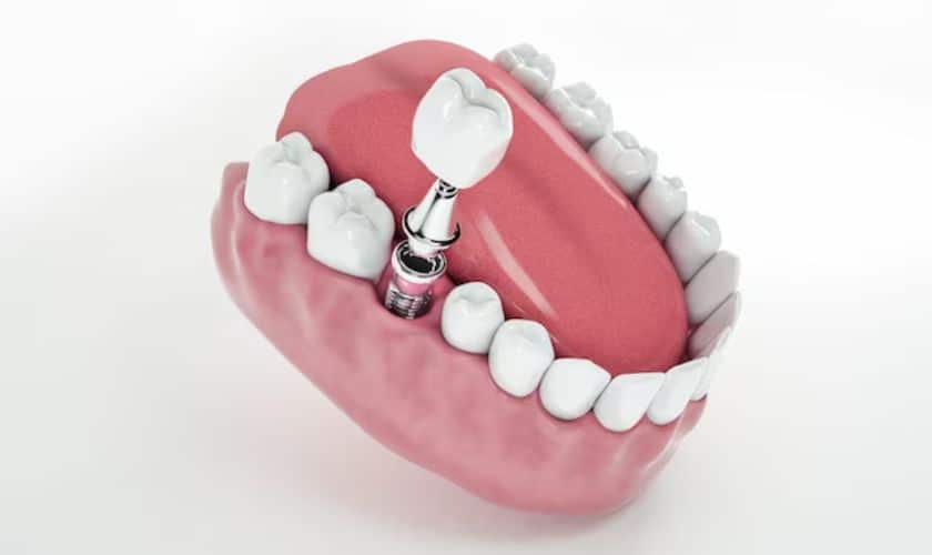Why Dental Implants are the Long-Term Solution for Missing Teeth