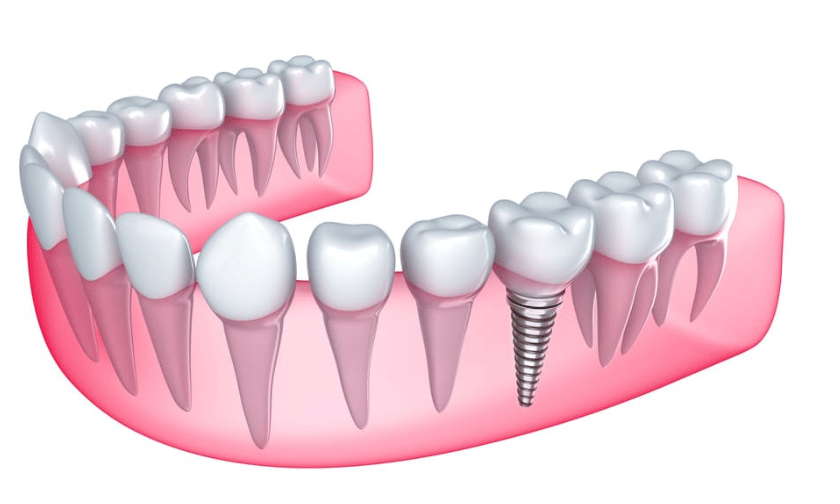 Dental Implants