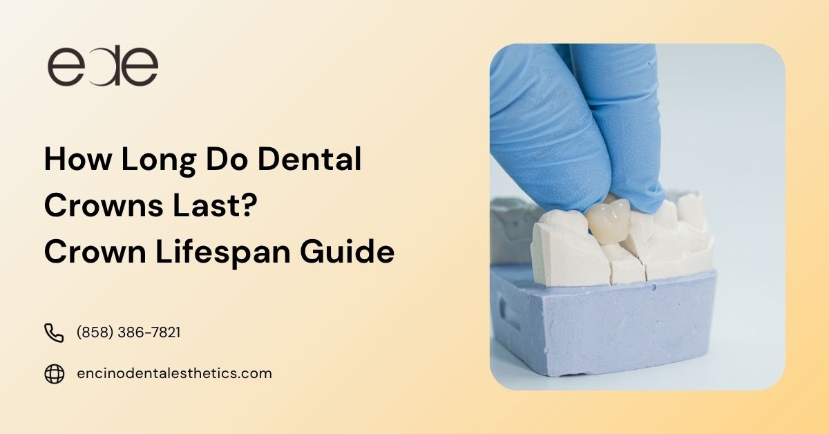 Dental crown on a tooth model for a dental crown lifespan guide.