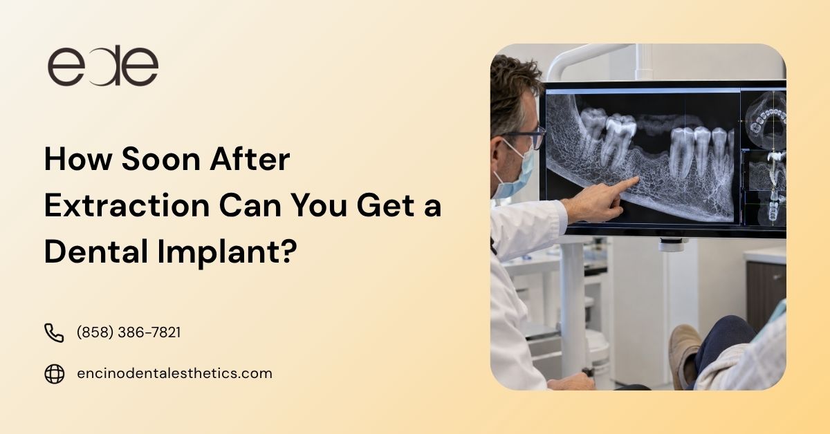 Why You Should Not Delay An Implant After Extraction?