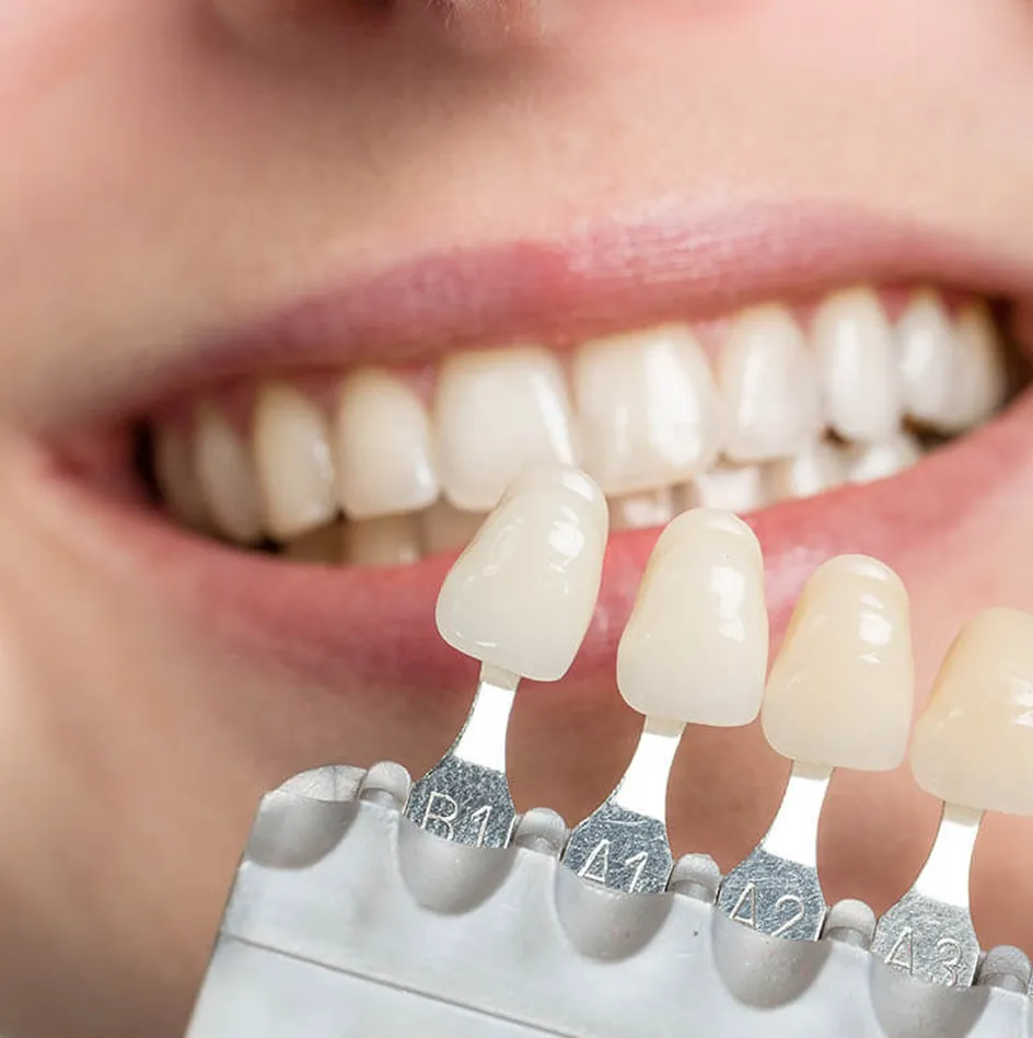 dental veneers different shades