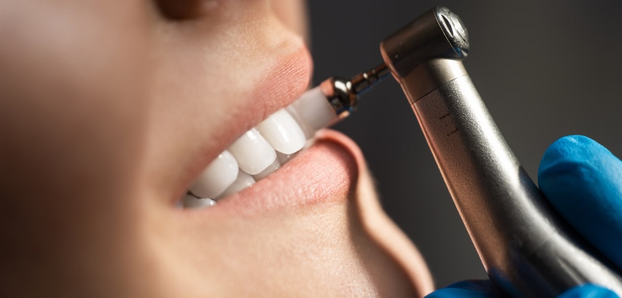 post-halloween dental cleaning